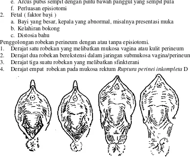 Gambar 6.  Derajat robekan perineum ( Depkes RI, 2004 : 5-13 ) 