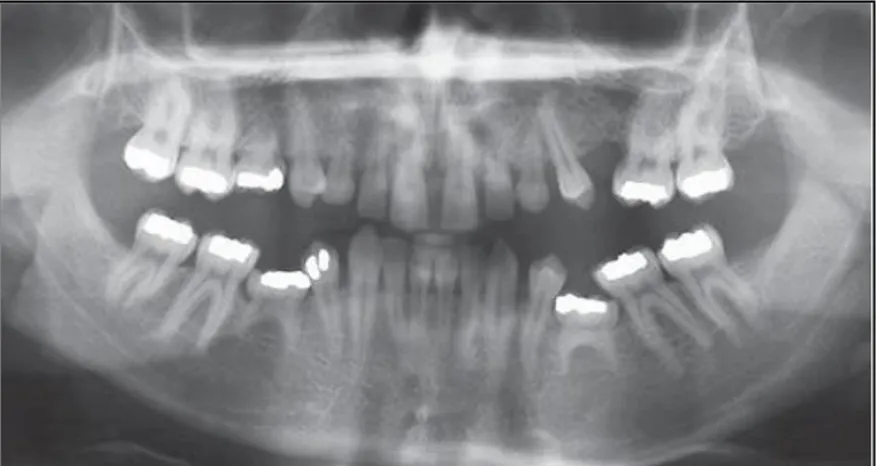 Gambar 2. Hypodontia gigi premolar kedua pada rahang  atas  dan  rahang  bawah  dan  kaninus  rahang  atas