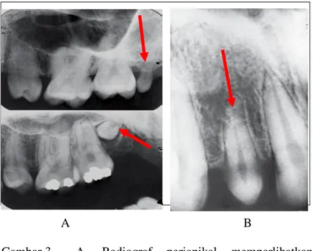 Gambar 3   A.  Radiograf  periapikal  memperlihatkan   berkurangnya  ukuran  gigi  pada  molar  ketiga  yang  mengalami  mikrodonsia  B