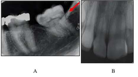 Gambar 4.   A.Makrodonsia  gigi  molar  menunjukan  peningkatan               dimensi  mesio  distal    dan  mesio  koronal-apikal 