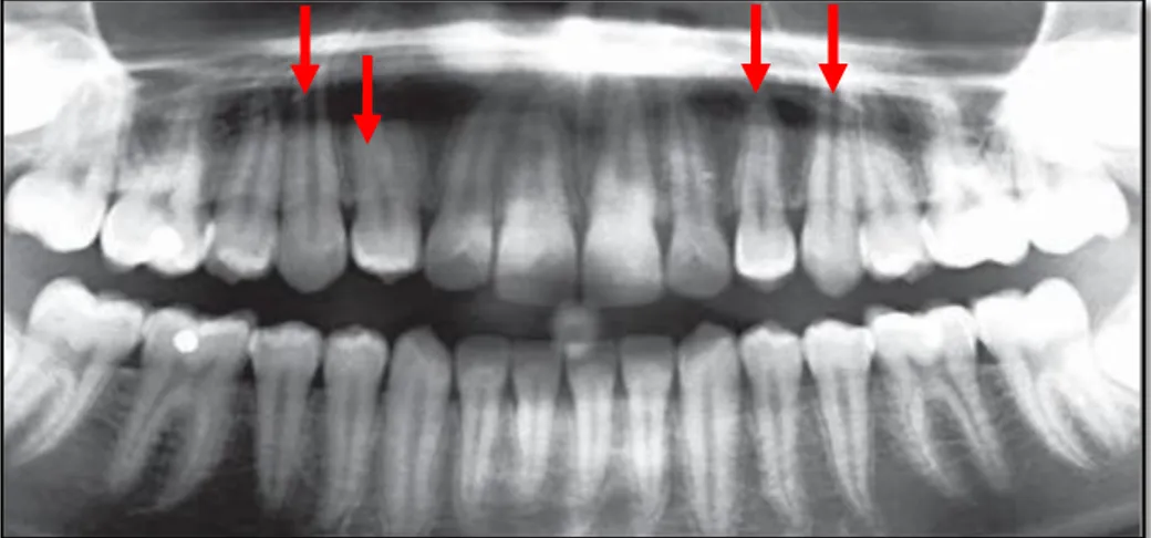 Gambar 5. Radiografi panoramik  memperlihatkan transposisi bilateral                    dari kaninus dan premolar pertama maksila 12 