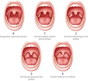 Gambar 6.  Sistem grading tonsil. A) T0 Post Tonsilektomi. B) 0-25%; T1. C)