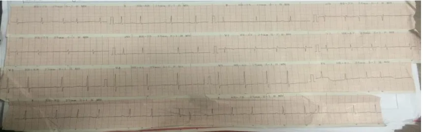 Gambar 1. Hasil elektrokardiogram kasus 1 