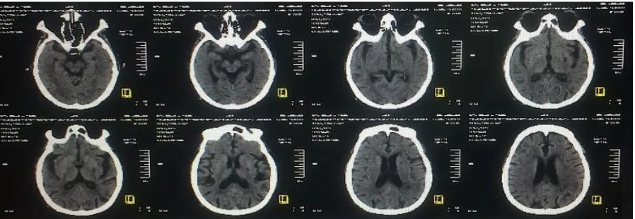 Gambar 2. Gambar CT-Scan kepala Kasus 1