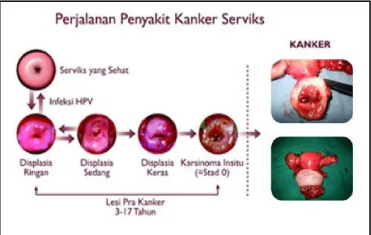 Gambar 2.2. Perjalanan Penyakit Kanker Leher Rahim  