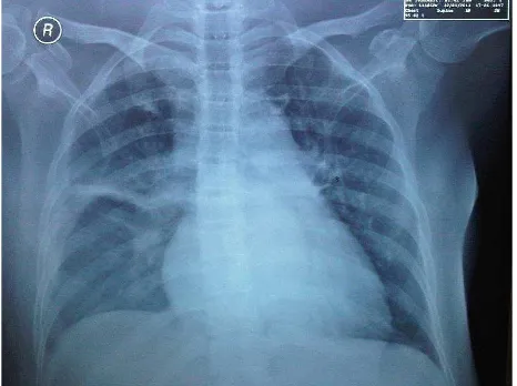 Figure 3. Chest X-ray day 19. Infiltration at both apices, posi-tive kerley line on the right middle lobe lung