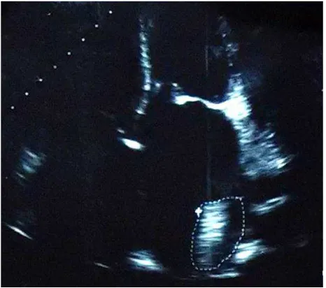 Figure 1. Four apical chamber view echocardiogram re-vealed a left atrial thrombus with approximate size of  8 cm2(white dashed line)