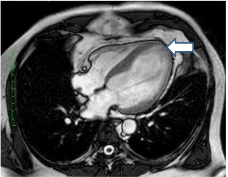 Figure 4. First magnetic resonance imaging (MRI) showed 15.6 mm x 8.5 mm thrombus at left ventricle apex (white arrow)