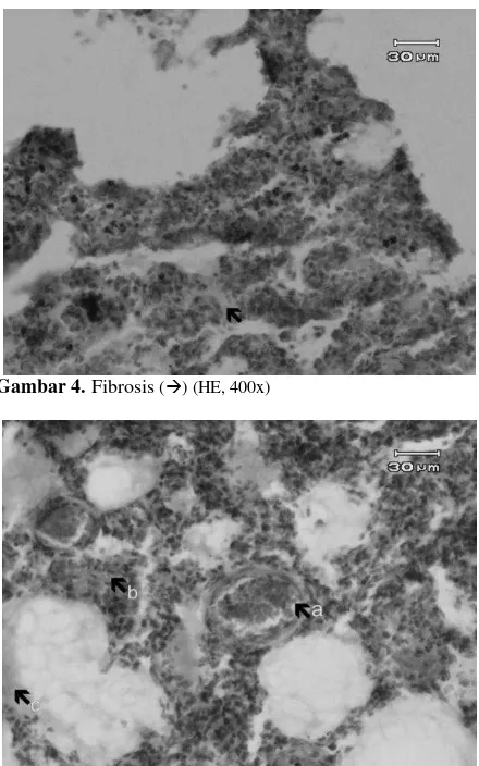 Gambar 4. Fibrosis () (HE, 400x) 