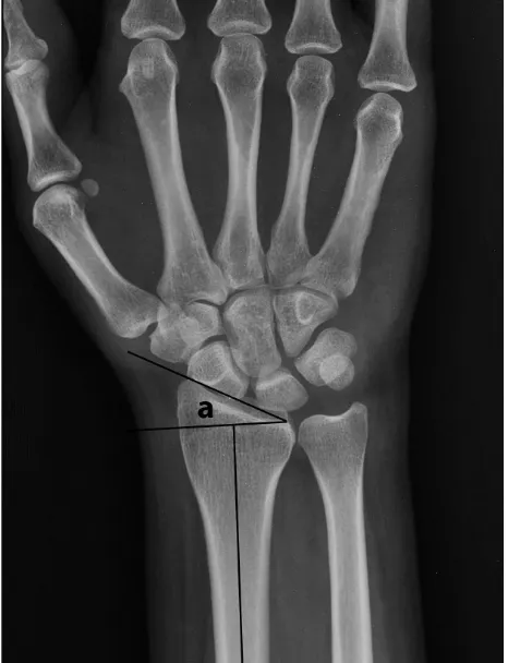 Figure 2.The measurement of palmar tilt. (b) is the palmar tilt, the angle formed by horizontal line perpendicular to the axis of radius at the level of radial styloid process with tangential line connecting dorsal and volar lip of distal radius