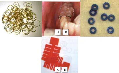 Gambar 2.5. Berbagai jenis separator.(A) Brass wire, (B) Kessling separator, (C) elastomer separator, dan (D) dumbbell separator