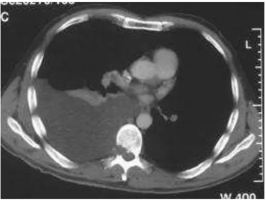Gambar 2.3 Gambaran efusi pleura tampak pada CT scan toraks (Lee YCG, 2013) 
