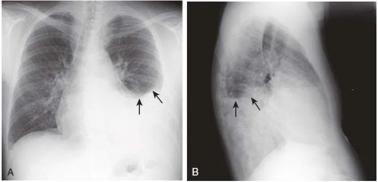 Gambar 2.1 (a) Efusi pleura kiri pada foto toraks tampak dari postero anterior dan lateral (b)