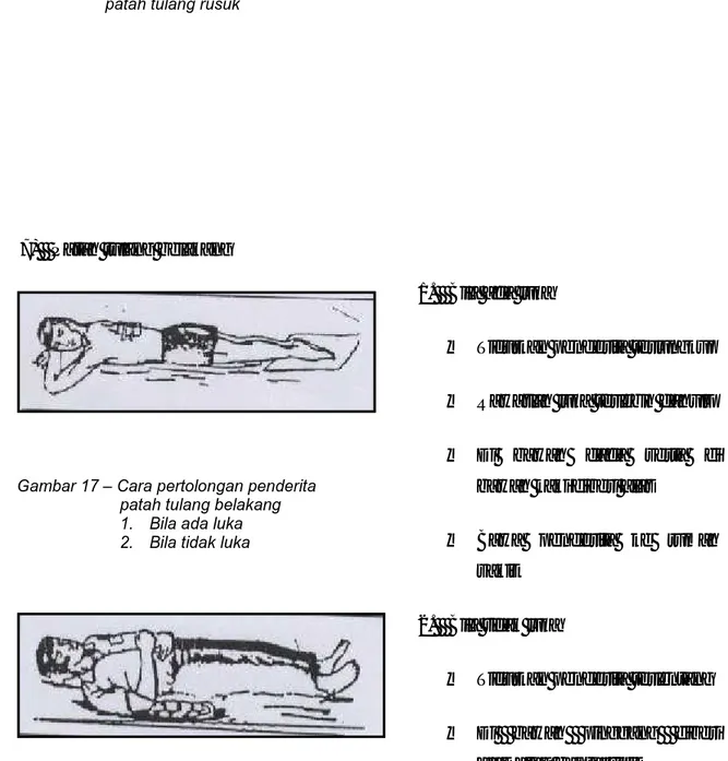 Gambar 16 – Cara pertolongan penderita patah tulang rusuk