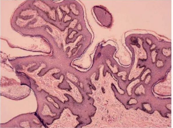 Gambar  2.9.  Dermatosis papulose nigra. Dikutip  dari kepustakaan no 39 