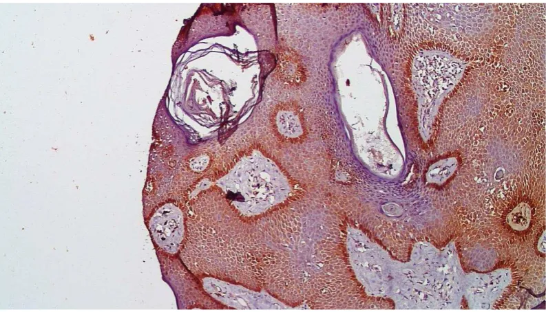 Gambar 3. Imunoekspresi endotelin-1 yang kuat  dengan skor  6  (intensitas 2       dan   densitas 3),  letak endotelin 1 pada lapisan  stratum basalis dan        stratum spinosum