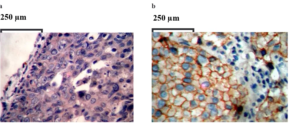Figure 4. E-cadherin, and NM23HI expression in primary tumor and its metastasis in lymph nodes                 a= E-cadherin, b= NM23HI