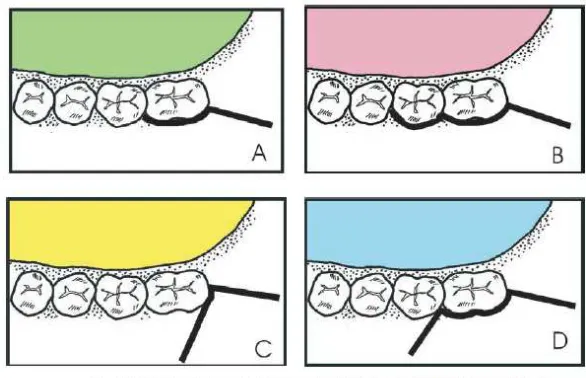 Gambar 6. Desain Flep. (A) Envelope flap pendek (B) Envelope flap panjang (C) Triangular flap pendek (D) Triangular flap panjang.12 