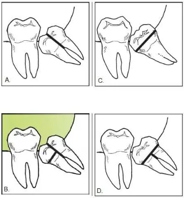 Gambar 7. Cara pembelahan gigi M3 mandibula impaksi mesioangular.12
