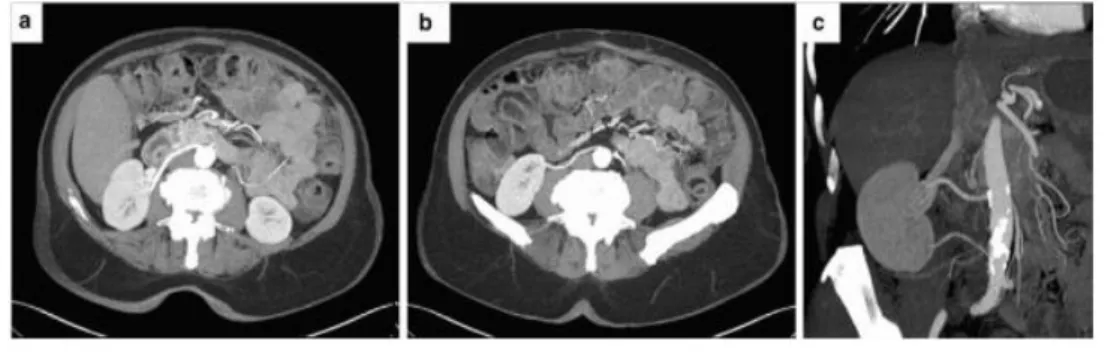 Gambar 6. CT Scan yang Memperlihatkan Arteri Renalis Precaval Sebelah Kanan (a,b). 8 