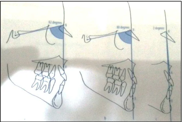 Gambar 1.Gambaran skeletal Klas I , (a) Sudut SNA normal, SNA 82˚(b) Sudut SNB normal, (c) Sudut ANB normal.16  