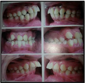 Gambar 2. Contoh maloklusi Klas I ; (A danB) bimaksiler protrusi,  (C dan D) crowding, (D dan E) proklinasi gigi anterior.17 