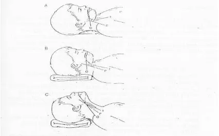Gambar 6. A. Sudut antara oral (O), faringeal (P) dan trakea (T) pada anak berusia 2 tahun bila anak terbaring datar