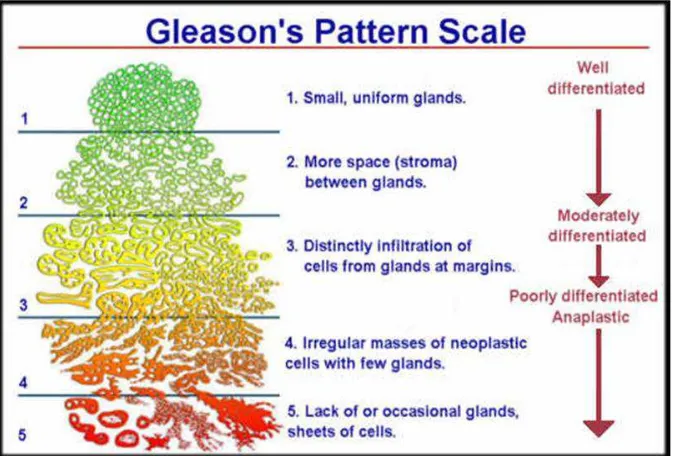 Gambar  2.1. Gleason grading pada adenokarsinoma prostat.13