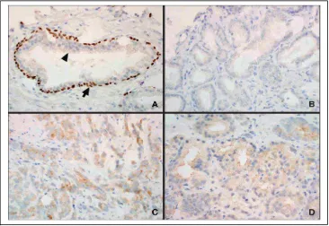 Gambar 2.7.A. Tampilan p63 pada sel basal kelenjar prostat normal;  B. Pewarnaan p63 negatif baik di sitoplasma maupun inti pada adenokarsinoma prostat; C dan D