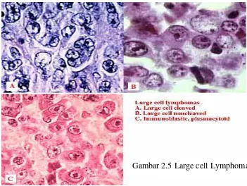 Gambar 2.5 Large cell Lymphoma2 
