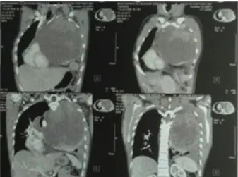 Gambar 1. CT scan toraks dengan kontras tanggal 13 Juli 