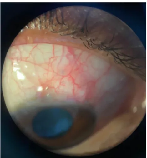 Gambar 1. Foto klinis mata kanan sebelum tindakan bleb needling 
