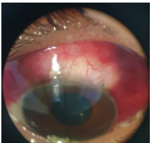 Gambar 2. Foto klinis mata kanan 1 hari setelah tindakan bleb needling 