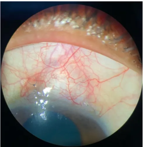 Gambar 3. Foto klinis mata kanan 6 minggu setelah tindakan bleb needling       Persiapan  operasi  dilakukan  pada  16  September  2020