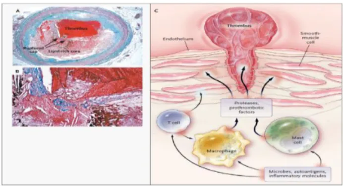 Gambar 3 . Proses Aterosklerosis. 