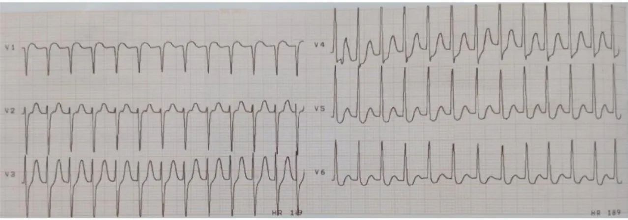 Gambar 1. Elektrokardiografi pasien yang menunjukkan irama SVT dengan denyut jantung  189kali/menit 