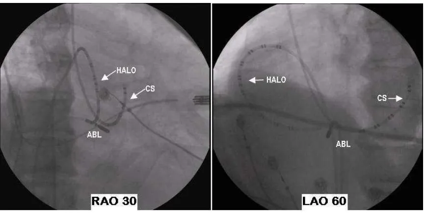 Figure 1. Fluoroscopy views of electrode and ablation catheters.  HALO = duodecapolar catheter placed around tricuspid annulus, CS = decapolar catheter placed inside coronary sinus with proximal pole at ostial, ABL = ablation catheter placed at cavotricusp