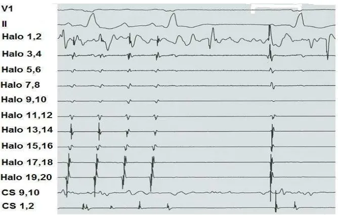 Figure 2. Intracardiac electrogram of typical atrial flutter 