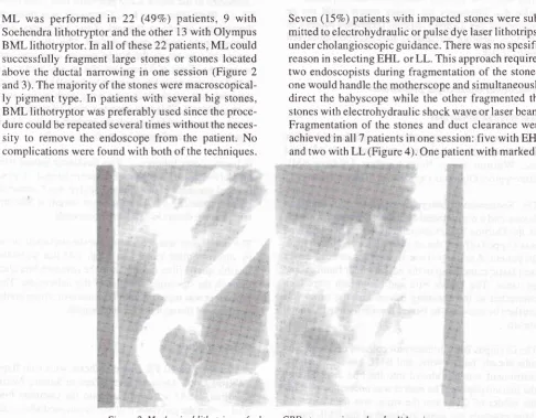 Figure.l. Outcome of difficult CBD stones using mechanical lithotripsy (ML), electohydraulic