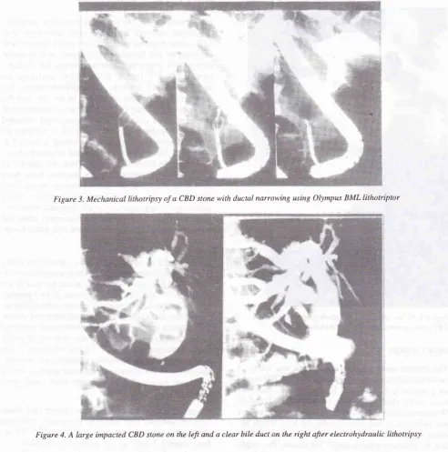 Figure 3. Mechanical lithotipsy of a CBD stone with ductal narrowing using Olympus BML lithotriptor