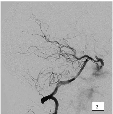 Figure 1.A) Pre-treatment diagnostic angiogram via right carotid artery from lateral view, B) AP view demonstrated a direct right CCF with torrential low to cavernous sinus and nearly absent of distal intracranial low