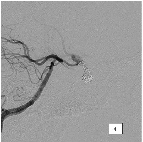 Figure 3.Post delivery of 2 GDC microcoils (arrow head) to the pre-clinoid carotid artery