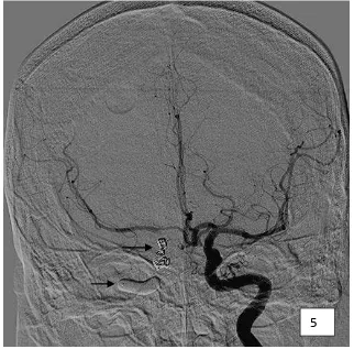 Figure 5. Final angiogram via left carotid artery post posterior coiling and glue (ar-row) and balloon occlusion at the proximal right carotid artery (arrow head) showed trapping of right istula’s low