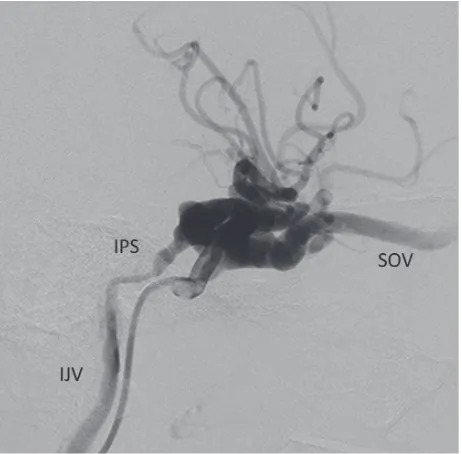 Figure 2. The posterior venous tributary of cavernous sinus (CS) was approached from internal jugular vein (IJV) using guiding catheter