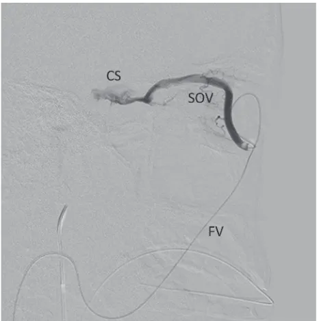 Figure 5. Long route of transvenous catheterization into cavernous sinus (CS) starting from facial vein (FV) with an acute turning point before reaching superior ophthalmic vein (SOV)