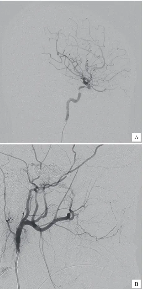 Figure 6. Post coiling embolization, angiography of right ICA (A) and ECA (B) showed a complete obliteration of istula and its retrograde venous low.