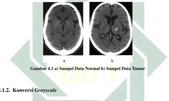 Gambar 4.1 a) Sampel Data Normal b) Sampel Data Tumor