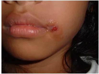 Figure. 1. A patient with history of crush injury has undergone initial debridement in the emergency setting