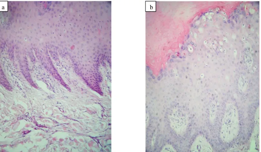 Figure 1. a) Solitary verruca vulgaris, hyperkeratotic, 3 x 2.4 x 0.4 cm nodule, b) Close up view