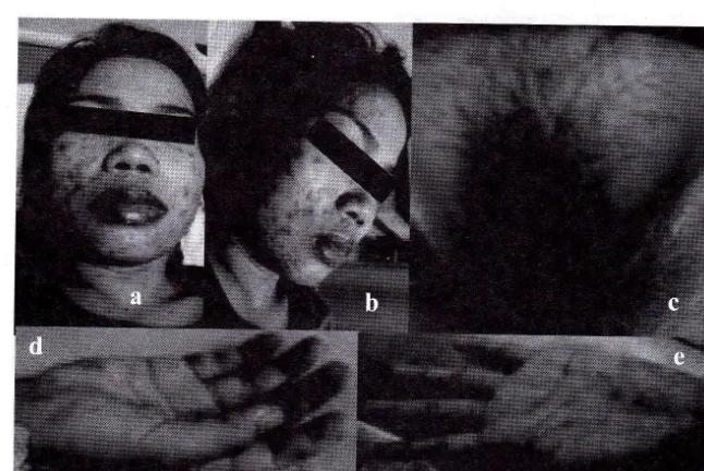 Gambar 1' Gambaran klinis pasien saat masuk rumah sakit(a-b) Regio facialis (c-d) Regio palmar \e) Regio labia minora